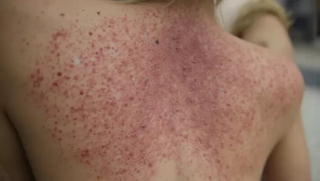 New Mpox Strain Detected in UK Traveler